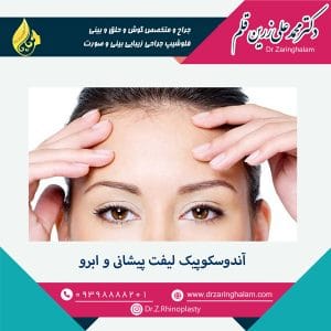 آندوسکوپیک لیفت پیشانی و ابرو
