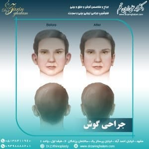 جراحی گوش - دکتر زرین قلم