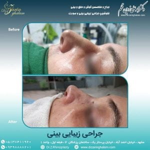 جراحی بینی باز - دکتر زرین قلم