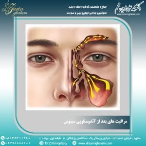 مراقبت های بعد از آندوسکوپی سینوس