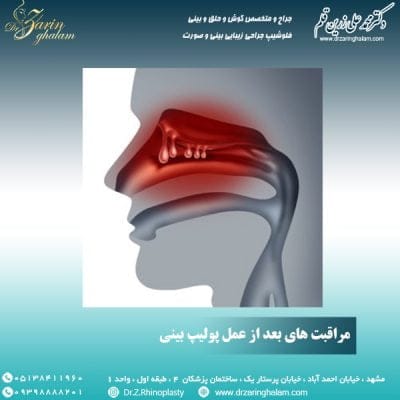 مراقبت های بعد از عمل پولیپ بینی - دکتر زرین قلم