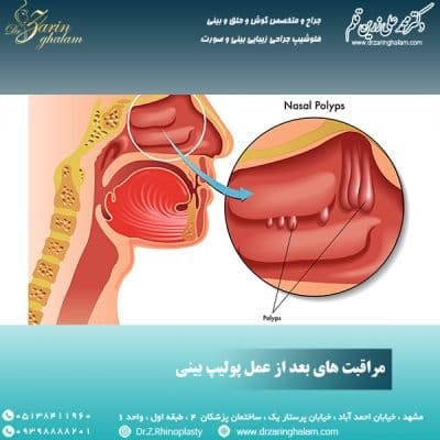 مراقبت های بعد از عمل پولیپ بینی - دکتر زرین قلم