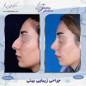 جراحی بینی در مشهد - دکتر زرین قلم
