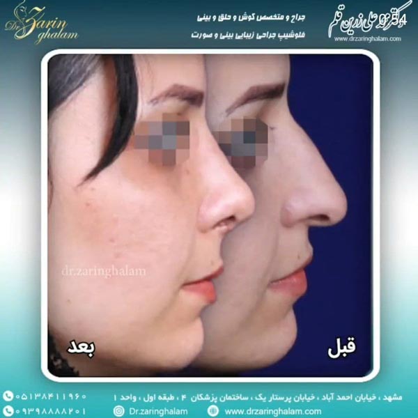 جراحی زیبایی بینی در مشهد