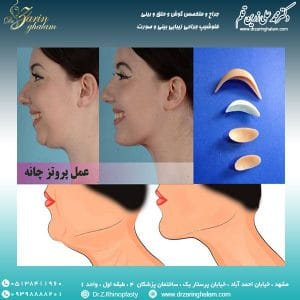 پروتز چانه در مشهد - دکتر زرین قلم