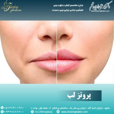 پروتز لب در مشهد - دکتر زرین قلم