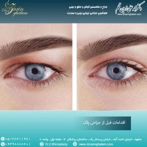 اقدامات قبل از جراحی پلک