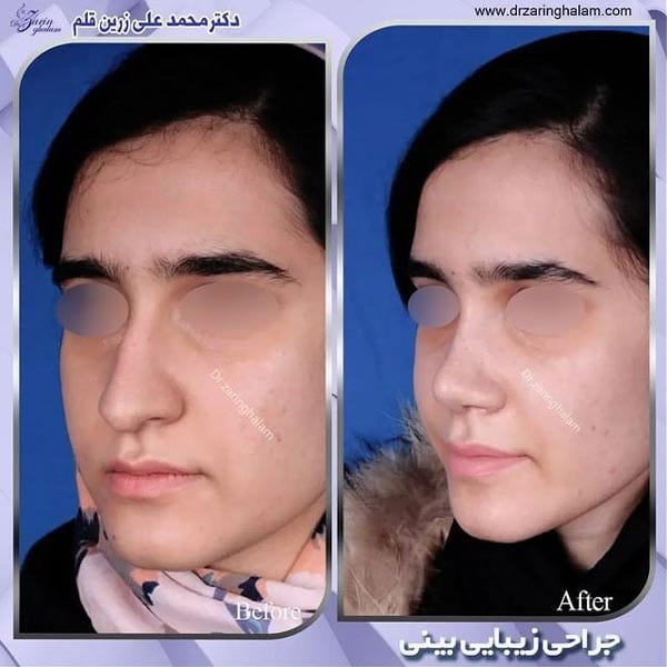 جراحی بینی طبیعی - دکتر زرین قلم