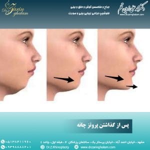 پروتز چانه در مشهد - دکتر زرین قلم