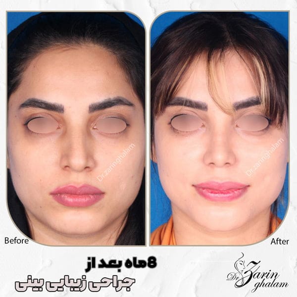 جراحی بینی طبیعی در مشهد - دکتر زرین قلم