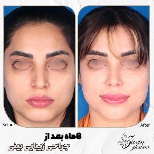 جراحی بینی در مشهد - دکتر زرین قلم