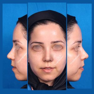 جراحی بینی استخوانی در مشهد با دکتر محمد علی زرین قلم ، جراح بینی خوب در مشهد با نمونه کارهای عالی و تصاویر قبل و بعد از عمل بینی