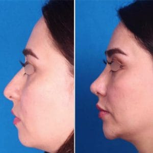 جراحی بینی طبیعی در مشهد - دکتر زرین قلم