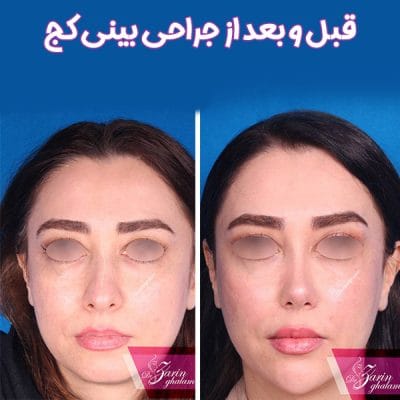 تصاویر قبل و بعد از جراحی بینی کج - دکتر زرین قلم