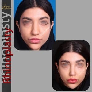 جراحی بینی گوشتی در مشهد - دکتر زرین قلم
