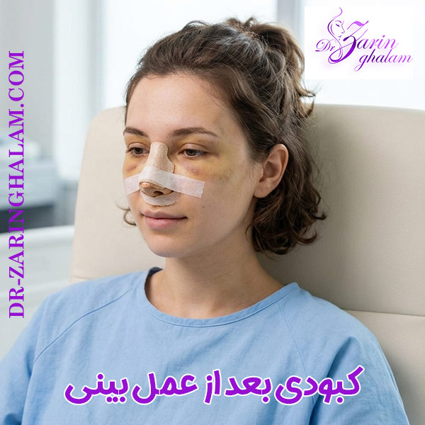 کبودی بعد از عمل بینی - دکتر زرین قلم