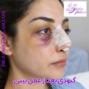 کبودی بعد از عمل بینی - دکتر زرین قلم