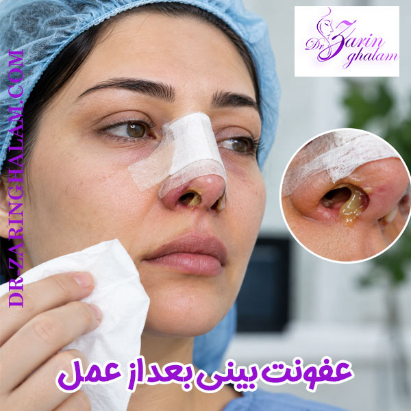 عفونت بینی بعد از عمل - دکتر زرین قلم