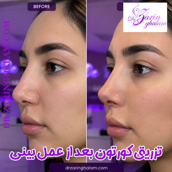 قبل و بعد از تزریق کورتون به بینی - دکتر زرین قلم