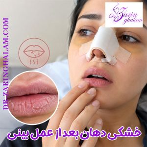 خشکی دهان بعد از عمل بینی - دکتر زرین قلم