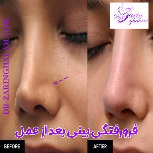فرورفتگی بینی بعد از عمل - دکتر زرین قلم