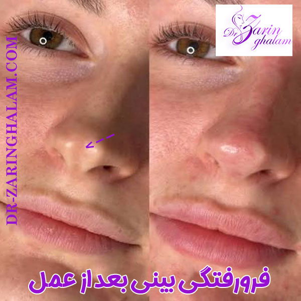 فرورفتگی بینی بعد از عمل - دکتر زرین قلم