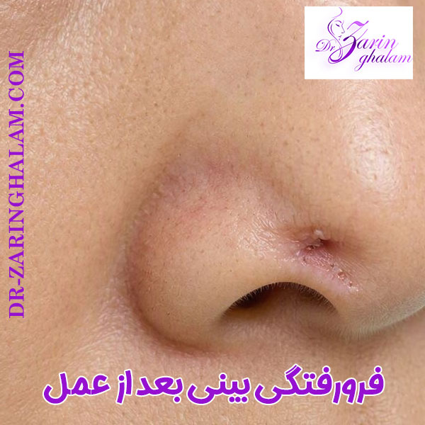 فرورفتگی بینی بعد از عمل - دکتر زرین قلم