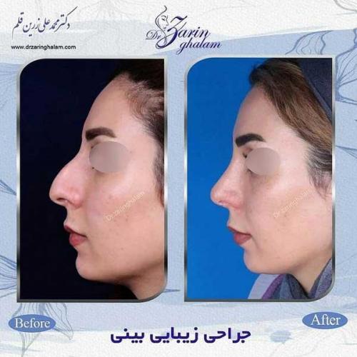 جراحی-بینی-100
