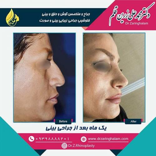 جراحی-بینی-11