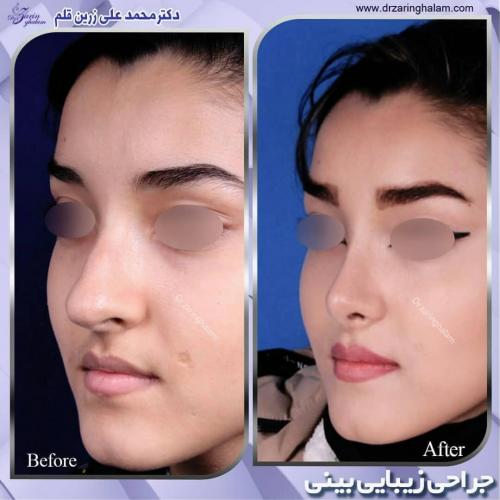 جراحی-بینی-192