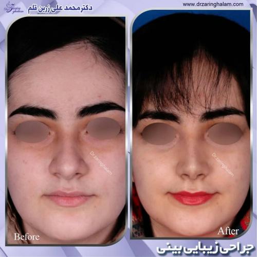 جراحی-بینی-193