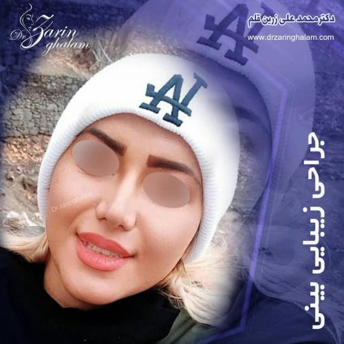 جراحی-بینی-200