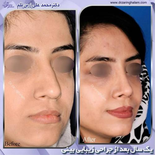 جراحی-بینی-203