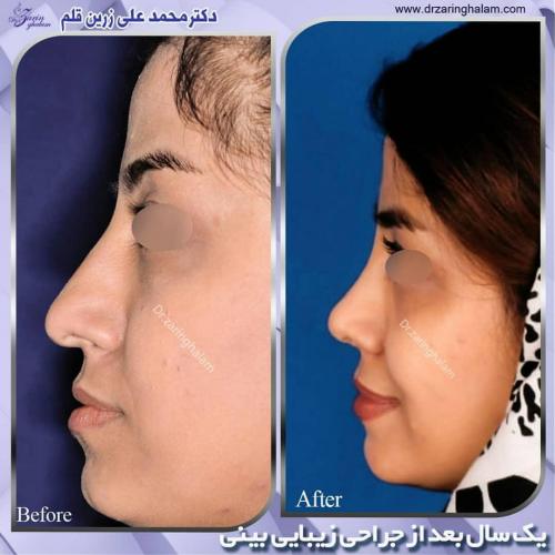 جراحی-بینی-204