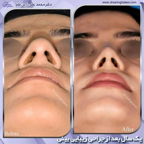 جراحی-بینی-207