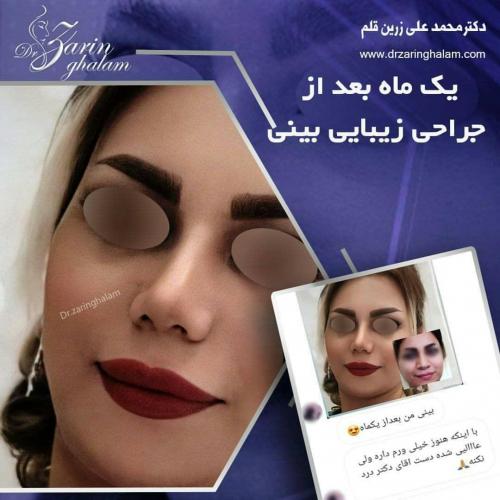 جراحی-بینی-211