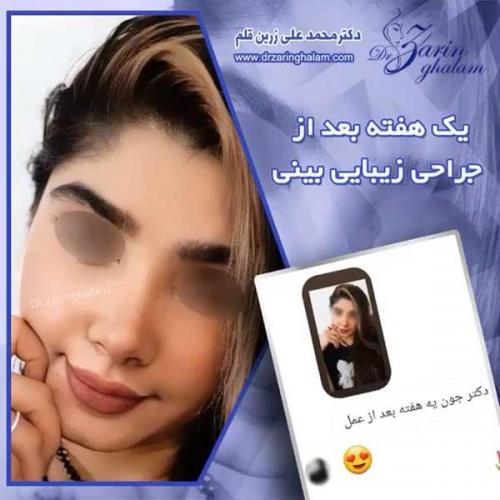 جراحی-بینی-216