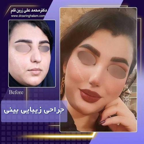 جراحی-بینی-219