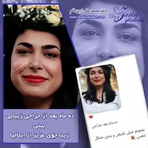 جراحی-بینی-319
