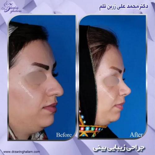 جراحی-بینی-323