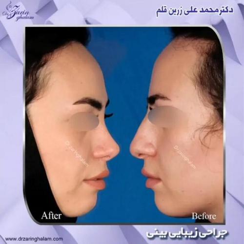 جراحی-بینی-324