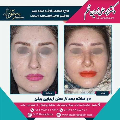 جراحی-بینی-33