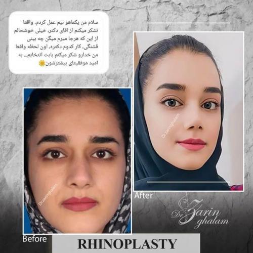 جراحی-بینی-350