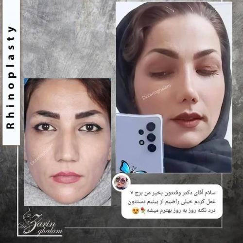 جراحی-بینی-371