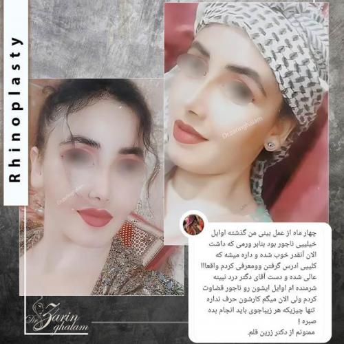 جراحی-بینی-373