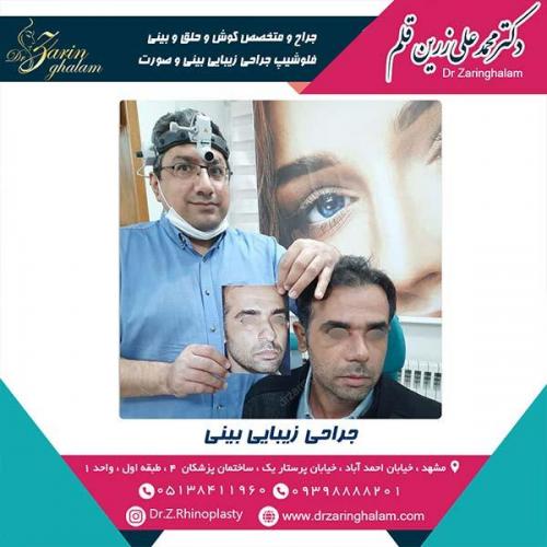 جراحی-بینی-44