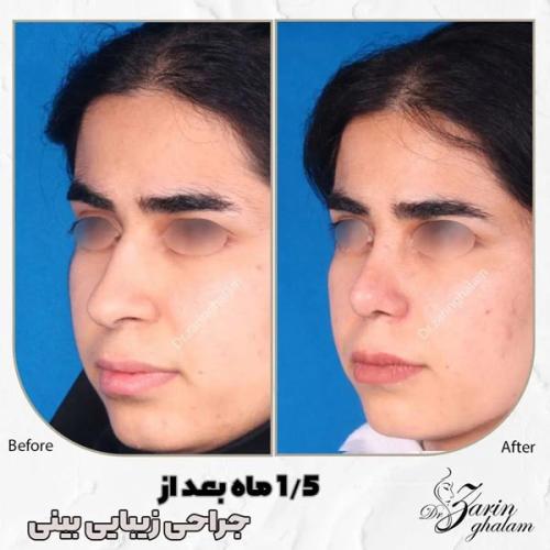 جراحی-بینی-505