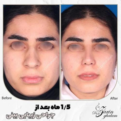 جراحی-بینی-506