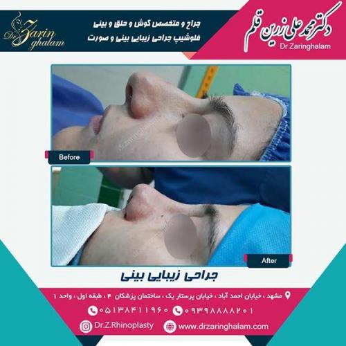 جراحی-بینی-51