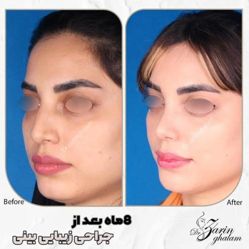 جراحی-بینی-510